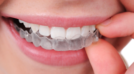 invisalign