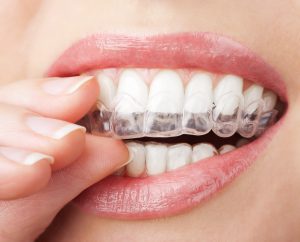 chip-aligners