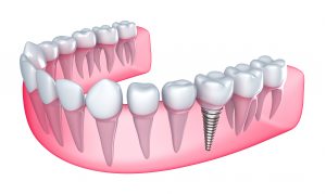 dentures