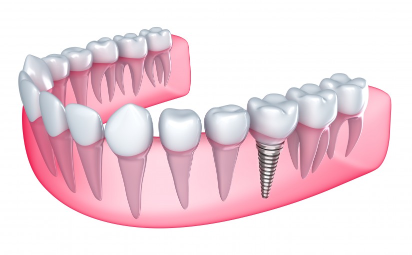 Implants – sucessfully used for replacing lost teeth