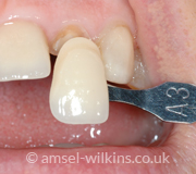 Matching Tooth Colour