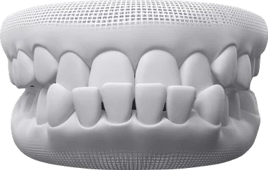 Underbite